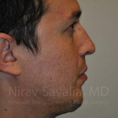 Oncoplastic Reconstruction Before & After Gallery - Patient 1655678 - After