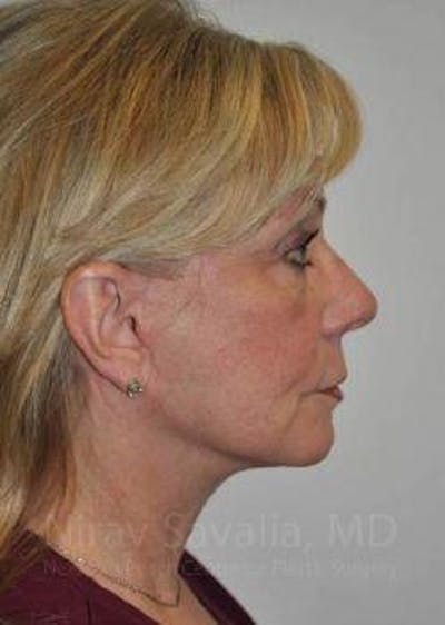 Breast Lift with Implants Before & After Gallery - Patient 1655682 - After