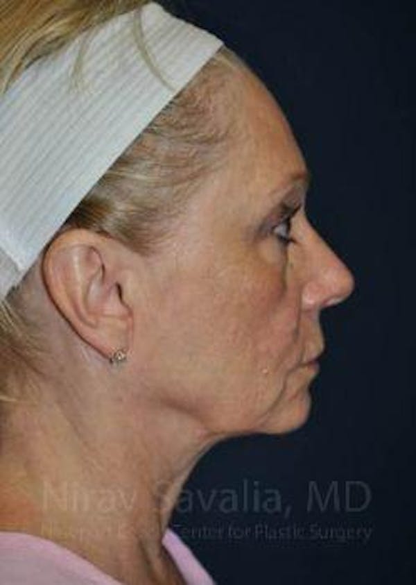 Chin Implants Before & After Gallery - Patient 1655681 - Before