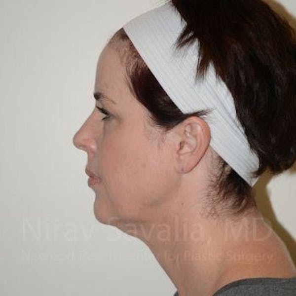 Chin Implants Before & After Gallery - Patient 1655683 - Before