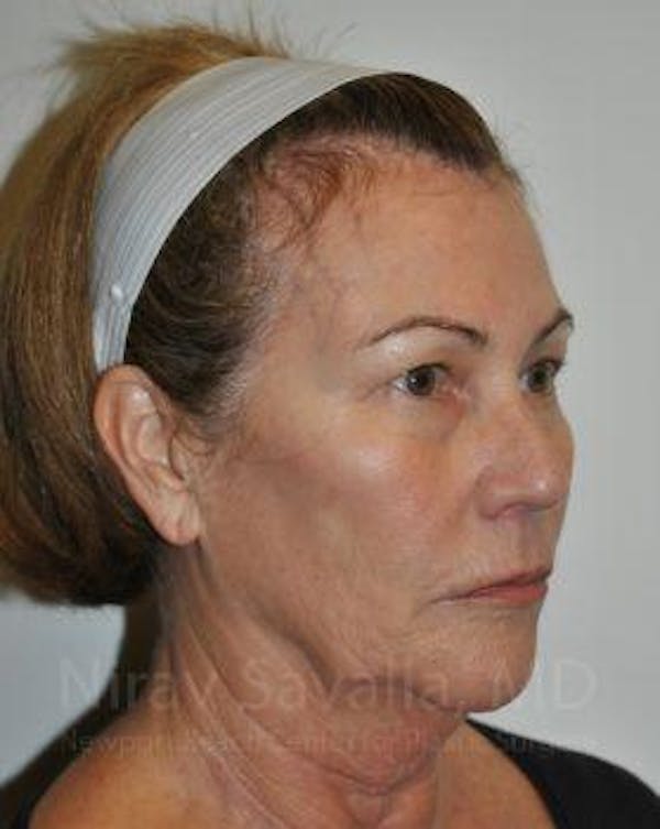 Oncoplastic Reconstruction Before & After Gallery - Patient 1655680 - Before