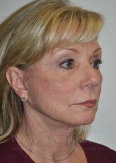 Chin Implants Before & After Gallery - Patient 1655682 - After