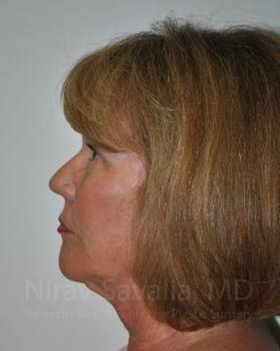 Chin Implants Before & After Gallery - Patient 1655680 - After