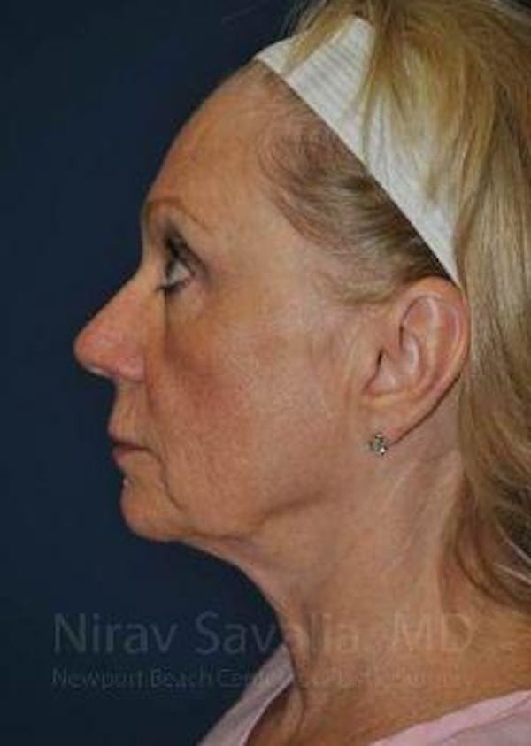 Oncoplastic Reconstruction Before & After Gallery - Patient 1655682 - Before