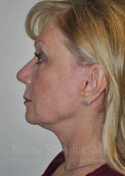 Oncoplastic Reconstruction Before & After Gallery - Patient 1655681 - After