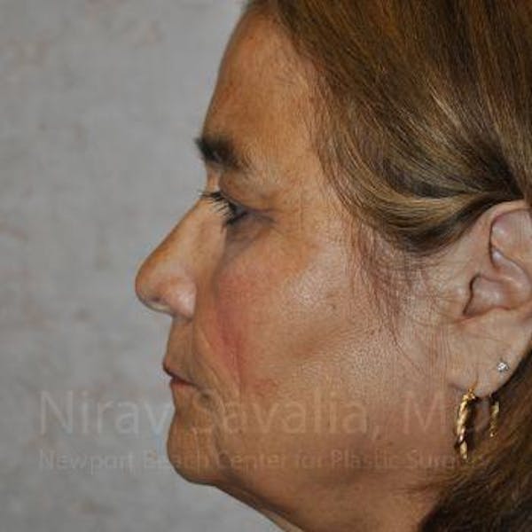 Chin Implants Before & After Gallery - Patient 1655687 - Before