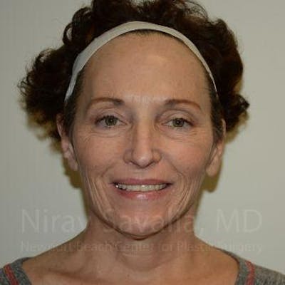 Oncoplastic Reconstruction Before & After Gallery - Patient 1655690 - Before