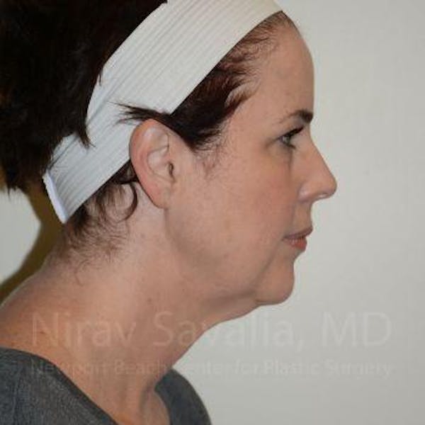 Chin Implants Before & After Gallery - Patient 1655688 - Before