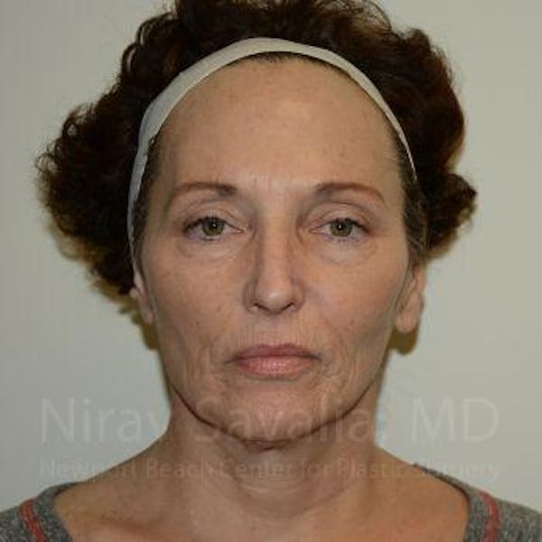 Chin Implants Before & After Gallery - Patient 1655690 - Before