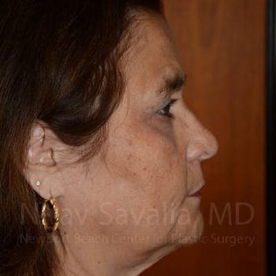 Chin Implants Before & After Gallery - Patient 1655687 - After