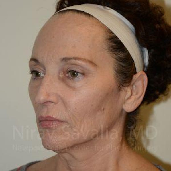 Chin Implants Before & After Gallery - Patient 1655690 - Before