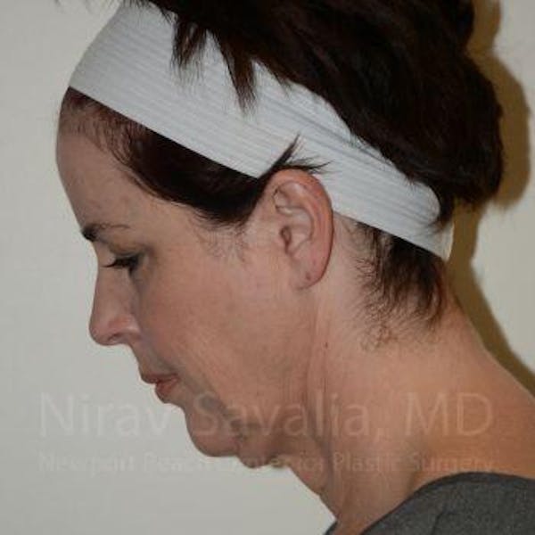 Chin Implants Before & After Gallery - Patient 1655688 - Before