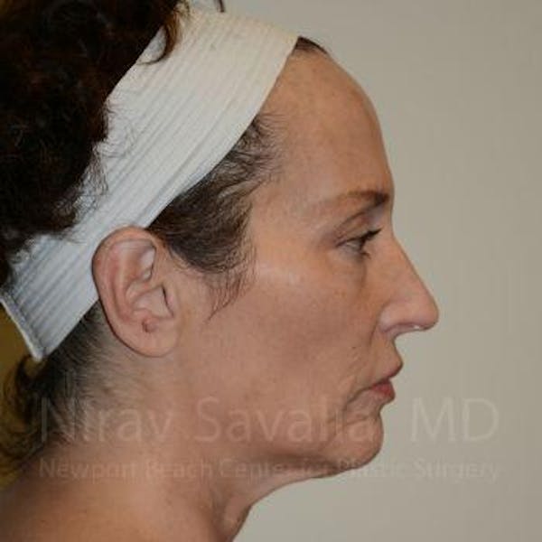 Chin Implants Before & After Gallery - Patient 1655690 - Before