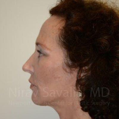 Chin Implants Before & After Gallery - Patient 1655690 - After