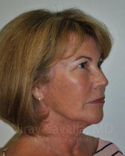 Oncoplastic Reconstruction Before & After Gallery - Patient 1655695 - After