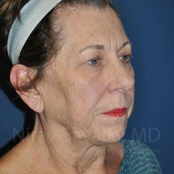 Chin Implants Before & After Gallery - Patient 1655696 - Before