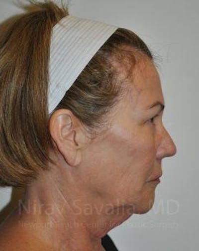 Brow Lift Before & After Gallery - Patient 1655695 - Before