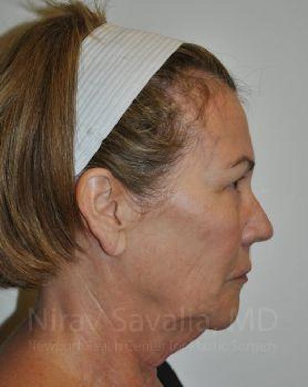 Liposuction Before & After Gallery - Patient 1655694 - Before