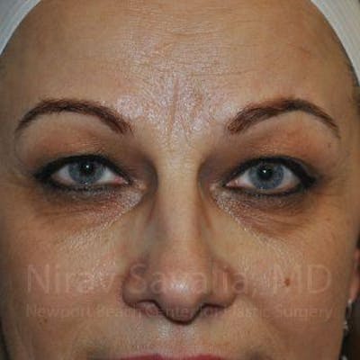 Chin Implants Before & After Gallery - Patient 1655701 - Before