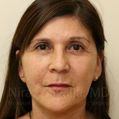 Mommy Makeover Before & After Gallery - Patient 1655702 - After
