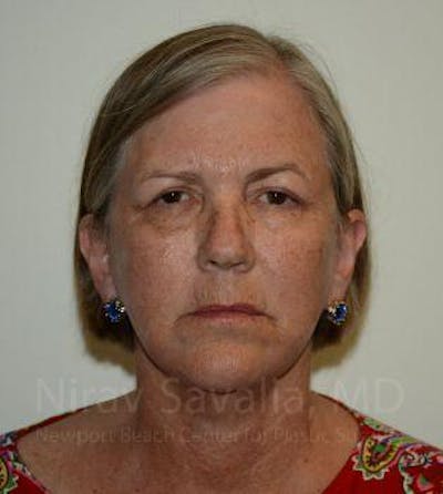 Chin Implants Before & After Gallery - Patient 1655699 - After