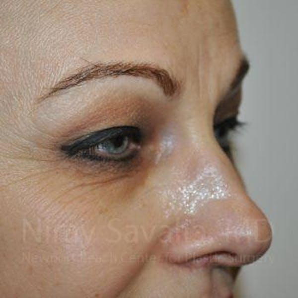 Brow Lift Before & After Gallery - Patient 1655701 - Before