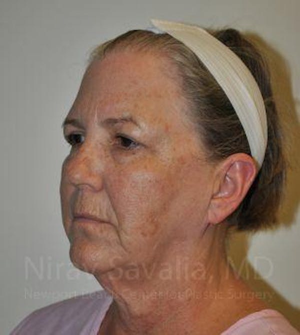 Chin Implants Before & After Gallery - Patient 1655699 - Before