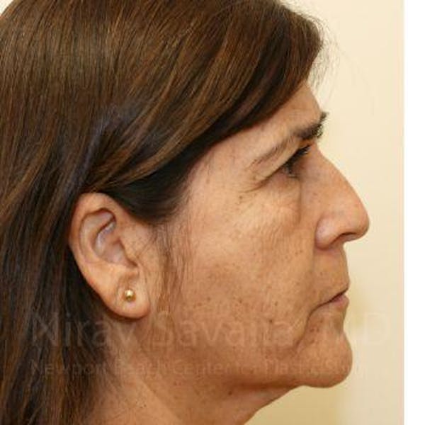 Oncoplastic Reconstruction Before & After Gallery - Patient 1655702 - Before