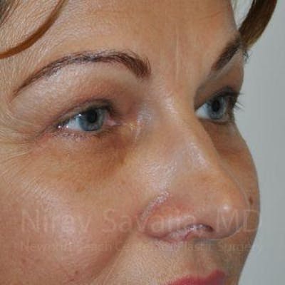 Brow Lift Before & After Gallery - Patient 1655701 - After