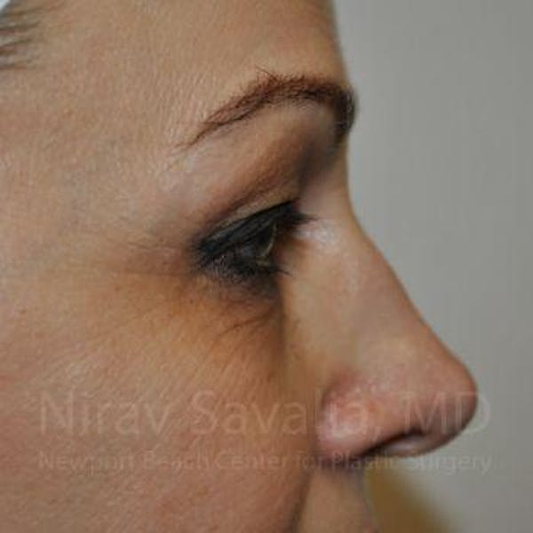 Mommy Makeover Before & After Gallery - Patient 1655701 - Before