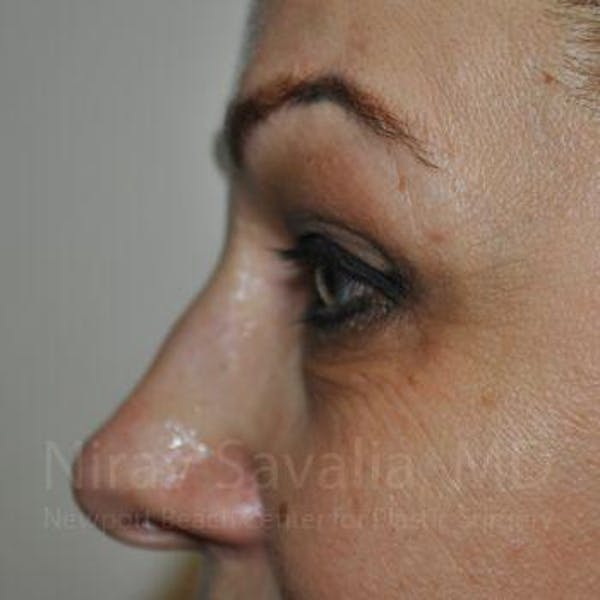 Brow Lift Before & After Gallery - Patient 1655701 - Before