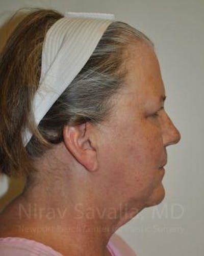 Mastectomy Reconstruction Before & After Gallery - Patient 1655699 - Before