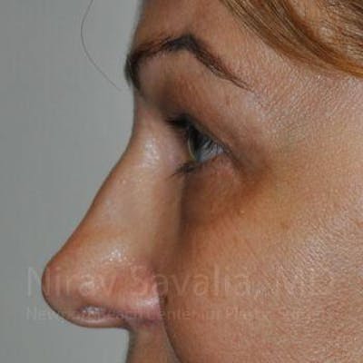 Mommy Makeover Before & After Gallery - Patient 1655701 - After