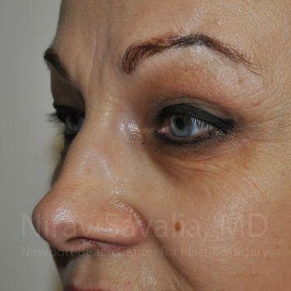 Brow Lift Before & After Gallery - Patient 1655701 - Before