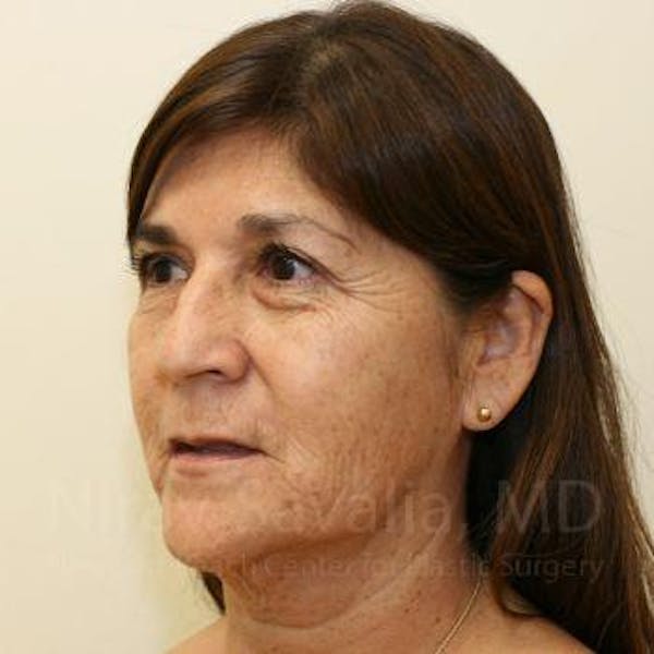 Chin Implants Before & After Gallery - Patient 1655702 - Before