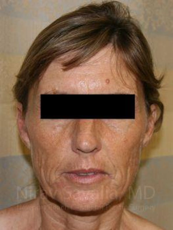 Chin Implants Before & After Gallery - Patient 1655704 - Before