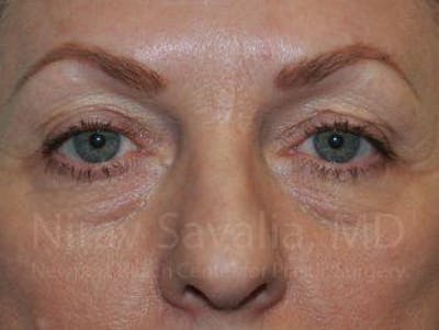 Oncoplastic Reconstruction Before & After Gallery - Patient 1655707 - Before