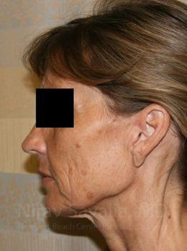 Chin Implants Before & After Gallery - Patient 1655704 - Before