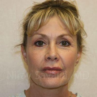 Mommy Makeover Before & After Gallery - Patient 1655706 - After