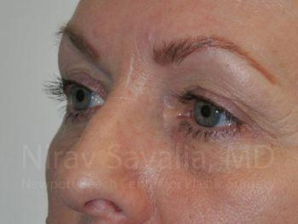 Brow Lift Before & After Gallery - Patient 1655707 - Before