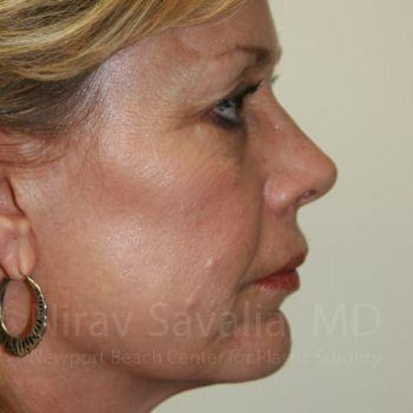 Mommy Makeover Before & After Gallery - Patient 1655706 - Before