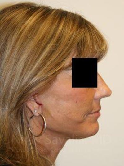 Oncoplastic Reconstruction Before & After Gallery - Patient 1655704 - After