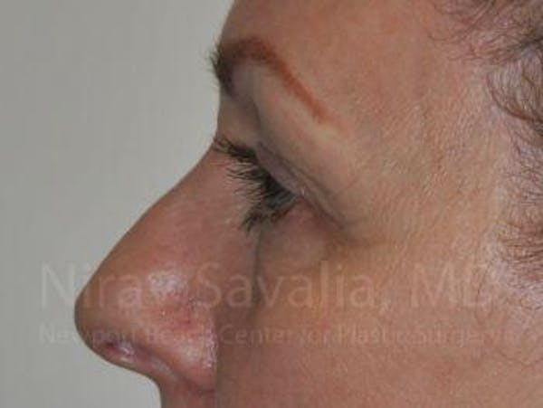 Oncoplastic Reconstruction Before & After Gallery - Patient 1655707 - Before