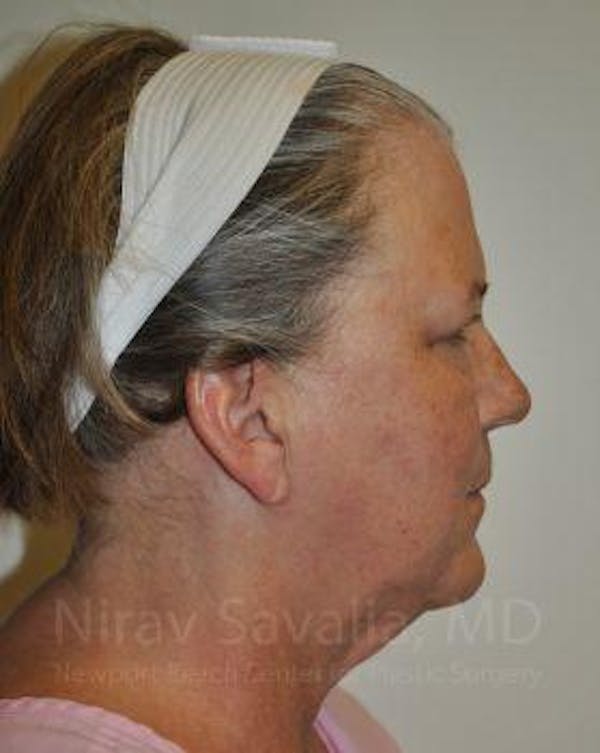 Mastectomy Reconstruction Before & After Gallery - Patient 1655705 - Before