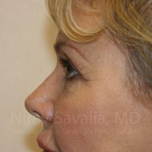 Breast Explantation En Bloc Capsulectomy Before & After Gallery - Patient 1655706 - Before