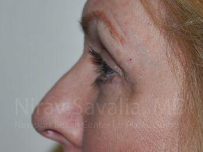 Brow Lift Before & After Gallery - Patient 1655707 - After