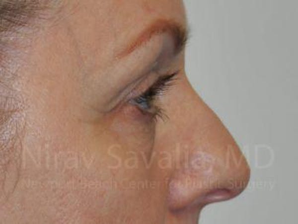 Brow Lift Before & After Gallery - Patient 1655707 - Before