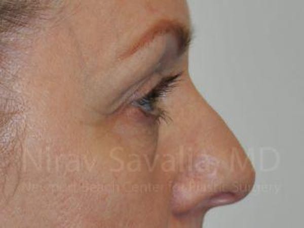 Chin Implants Before & After Gallery - Patient 1655707 - Before