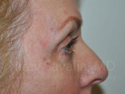 Brow Lift Before & After Gallery - Patient 1655707 - After