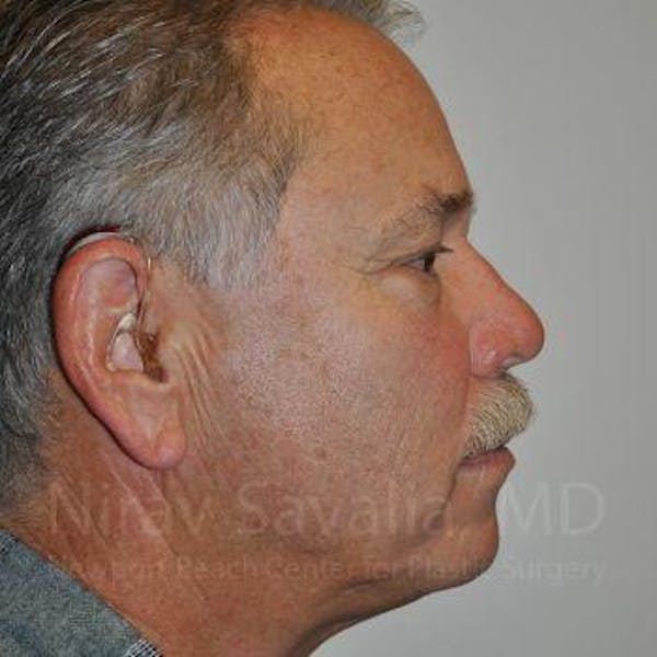 Chin Implants Before & After Gallery - Patient 1655711 - Before